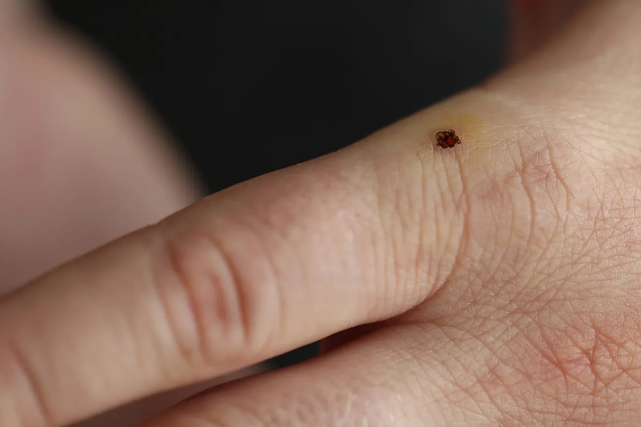 Bill seeks to require park signs about Lyme disease, tick bites